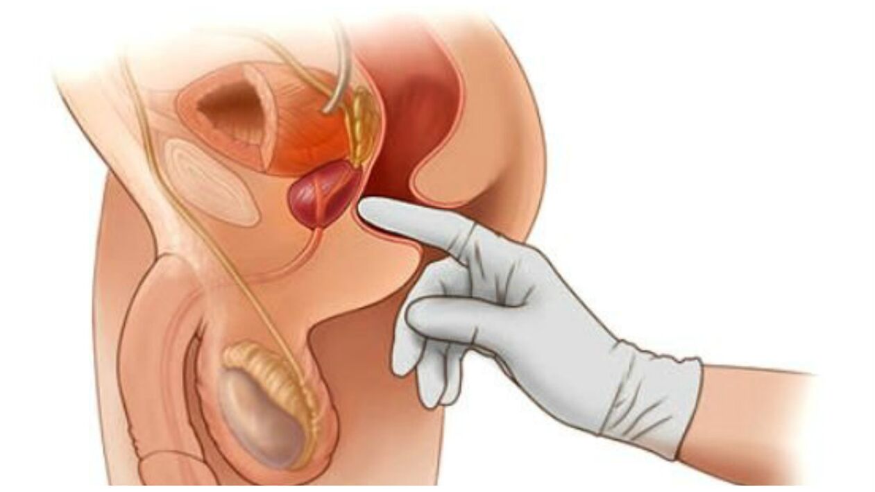 Prostatamassage fir chronesch Prostatitis