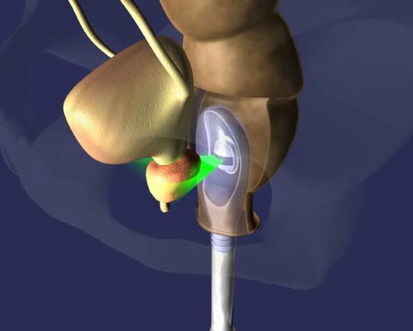 den Impakt vum Ultraschall op der Prostata mat Prostatitis
