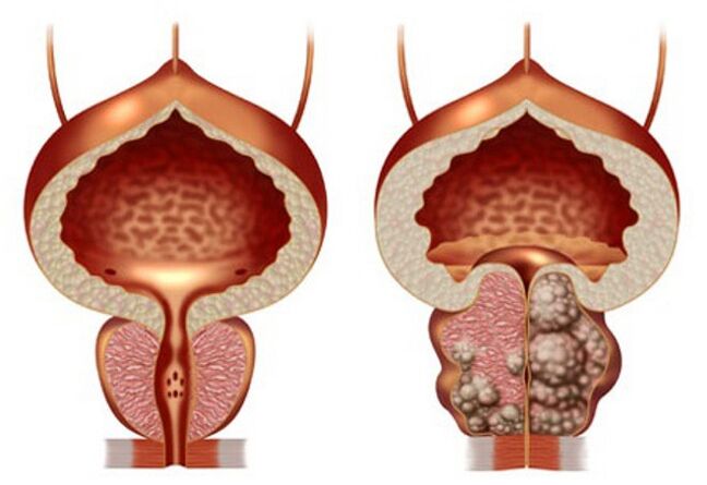 gesond Prostata a Prostataadenom