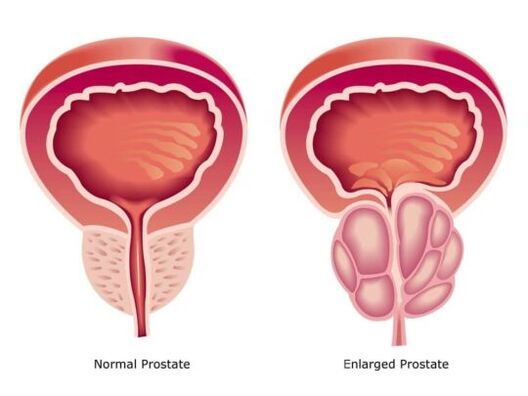 Normal a vergréissert Prostata