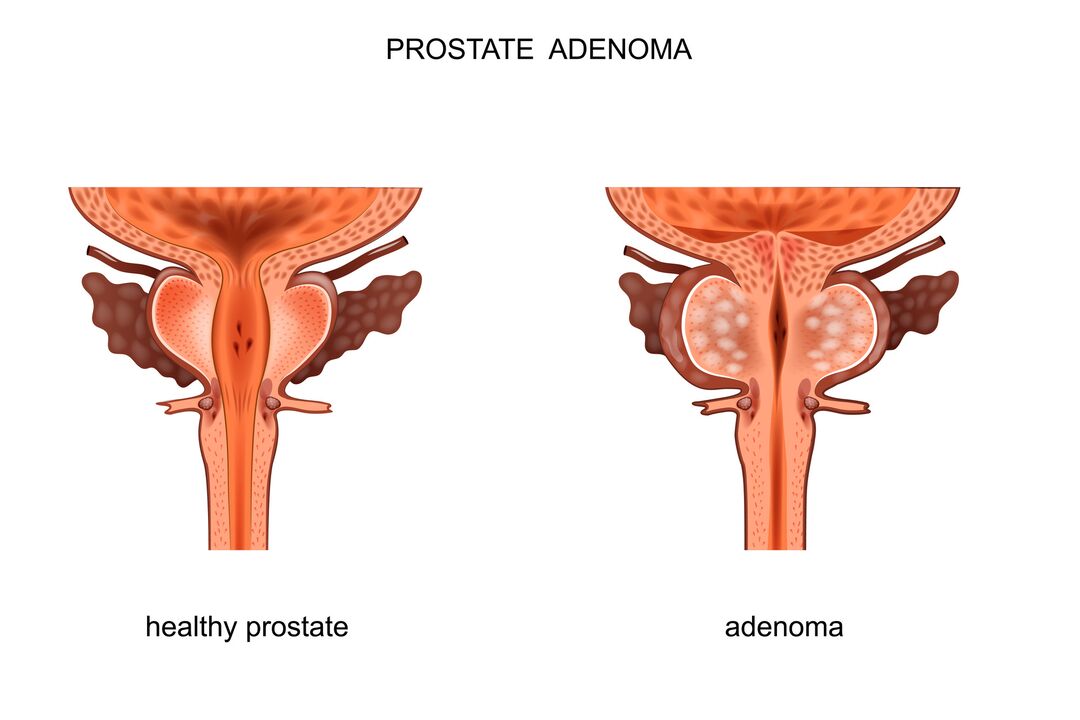 gesond Prostata a mat Adenom